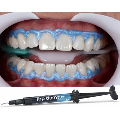 FGM Top Dam Light-Curing Gingival Barrier – Blue Resin (4 x 2g Syringes + Applicators) #4000019628