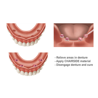 Zest Dental CHAIRSIDE Attachment Processing Material Normal Set 8gm #09566