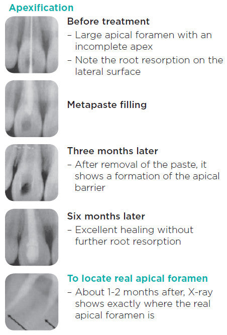 Metapaste Temporary Root Canal Filling Material, Calcium Hydroxide with Barium Sulfate