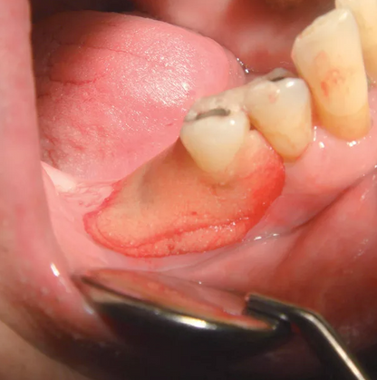 Hager Reso Pac Periodontal Dressing, Odor Free, No Mix Required